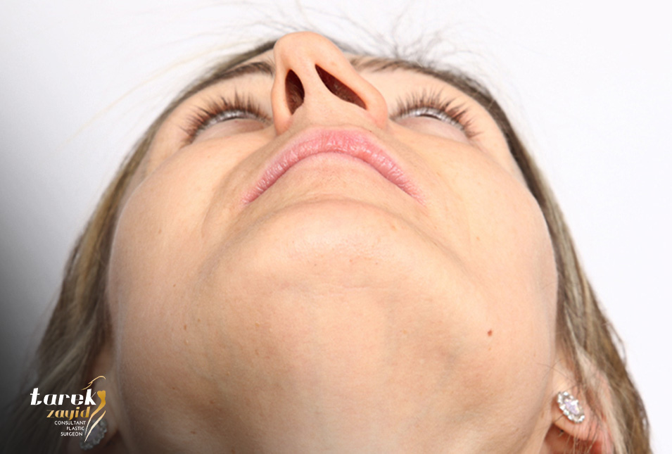 cost of-deviated-septum-surgery in-Egypt